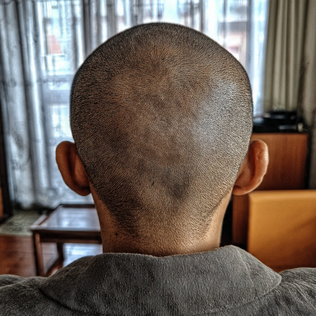 Buzz Cut for Balding Patterns